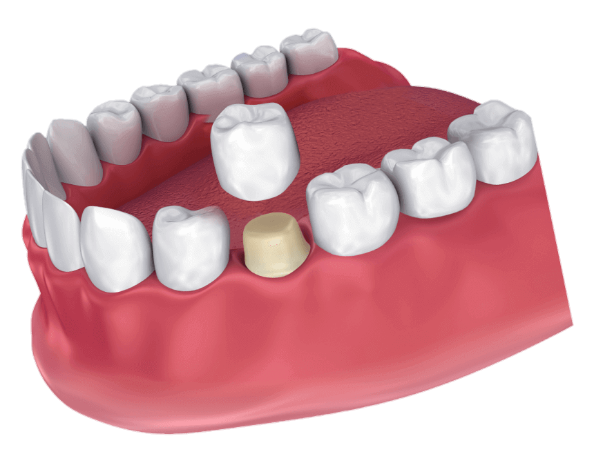 best dental-crown in ravet pune