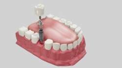 Dental Implants in Pune at low cost