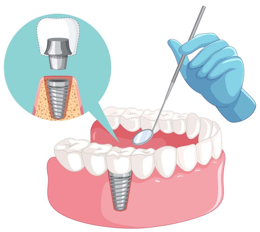 Best dental implant at ravet